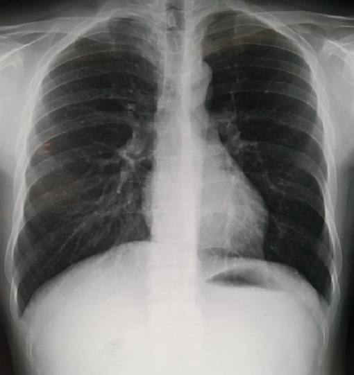 慢阻肺桶状胸图片图片