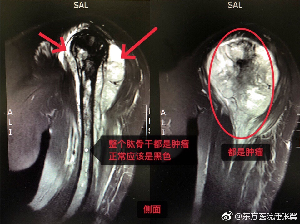 论是肩关节还是肘关节,整个上臂骨与周围软组织都完全被肿瘤组织侵蚀