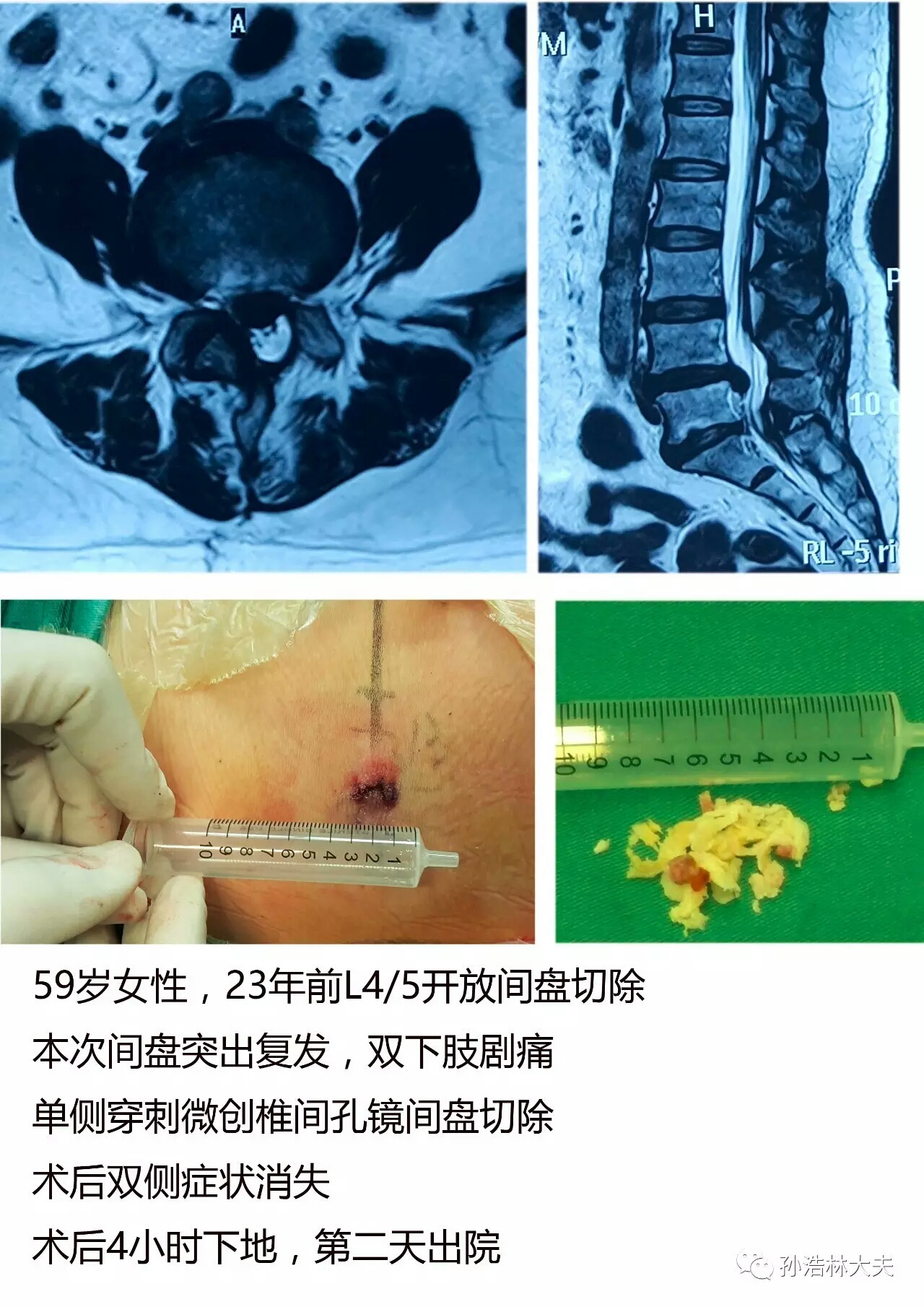 病例五,腰椎间盘突出症开放术后复发微创手术病例