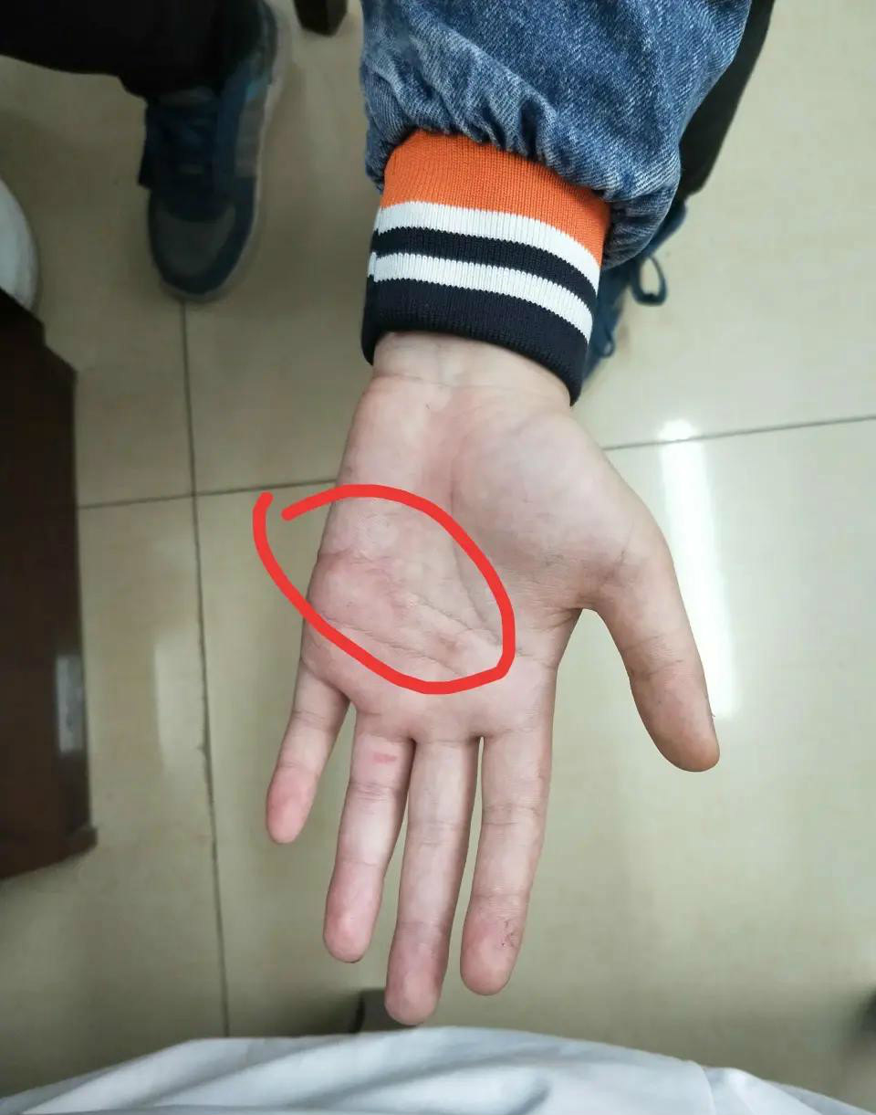 小朋友打扫卫生被玻璃划开一半手掌,筋都断了一大把……_姚京辉_副