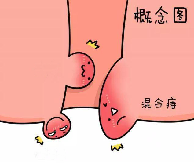 长沙看痔疮的医院哪家好?混合痔的危害有哪些?