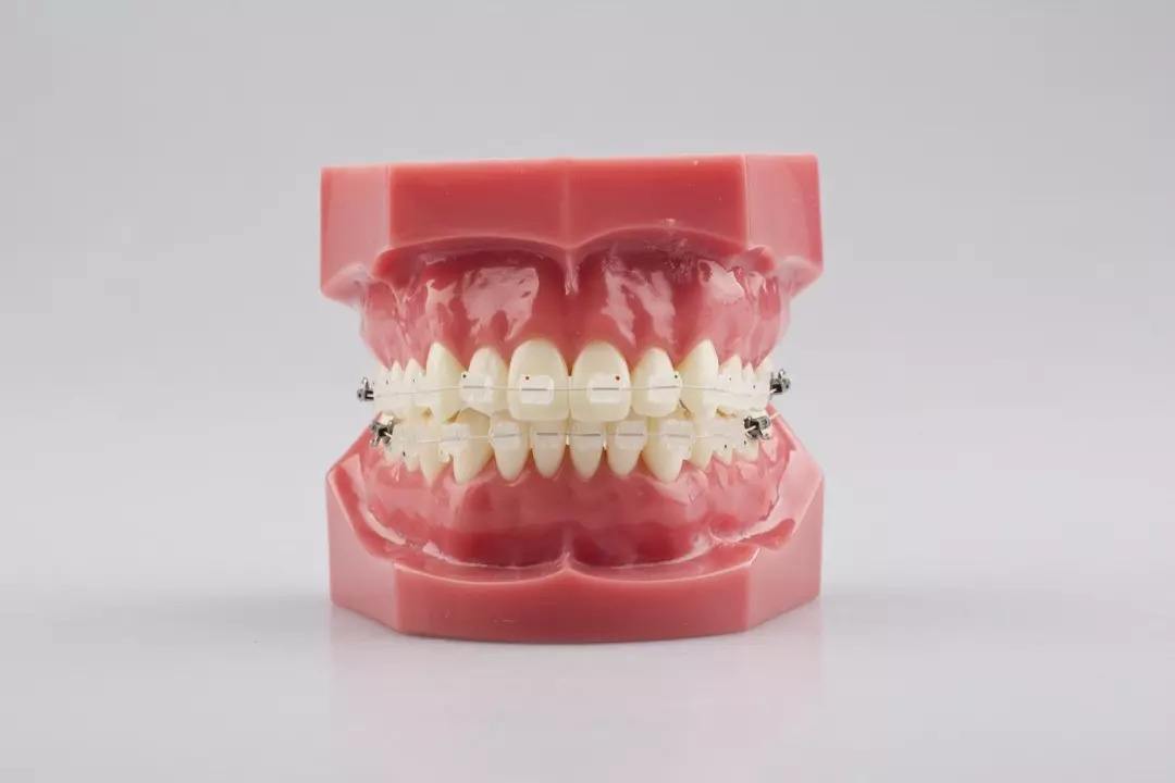 牙套种类多,不知怎么选?五分钟教你选到适合自己的牙套