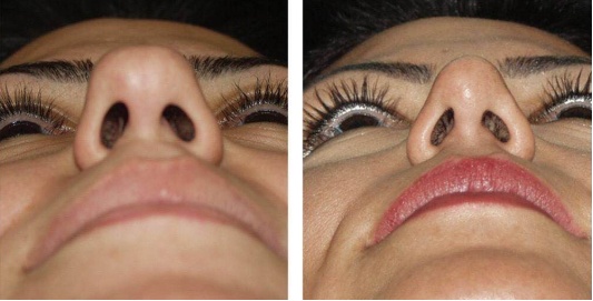 想缩鼻头鼻翼,你应该知道的事