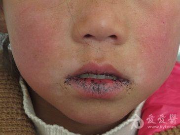 口周黑子.jpg