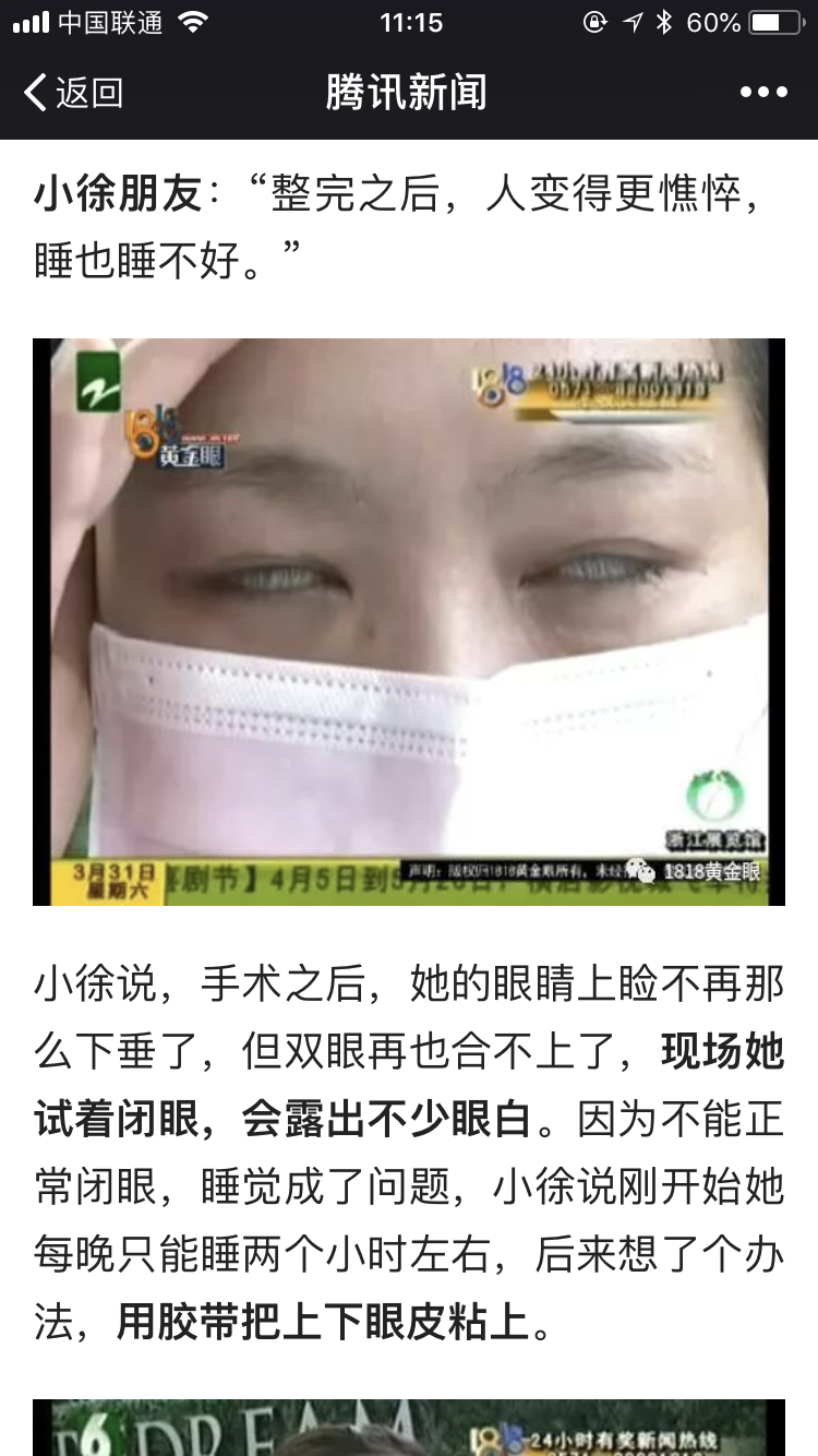 2.     闭眼时,暴露区域没有看见角膜组织(黑眼球),说明患者bell