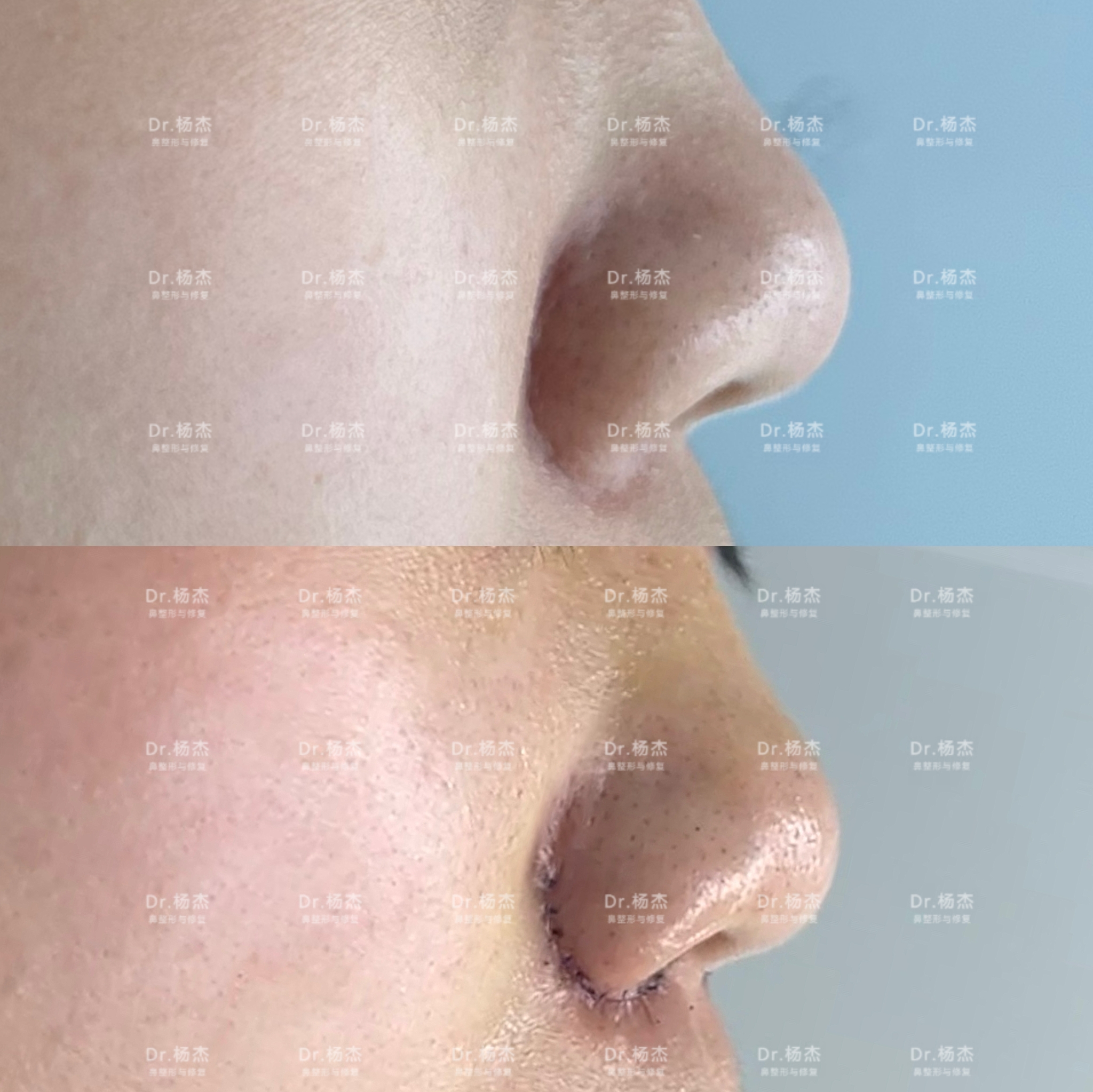 【内外联合鼻翼缩小 鼻槛上提】-杨杰-爱问医生