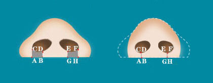 我鼻子太大看起来不秀气怎么改善