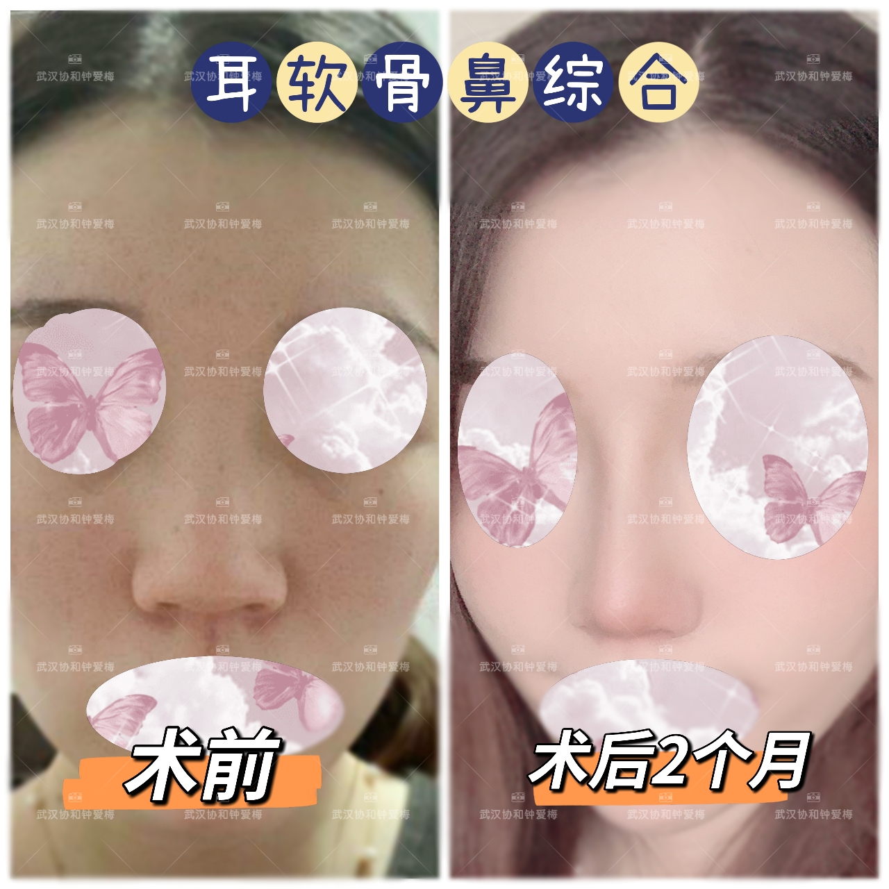 耳软骨鼻综合案例分享 钟爱梅副主任医师 爱问医生