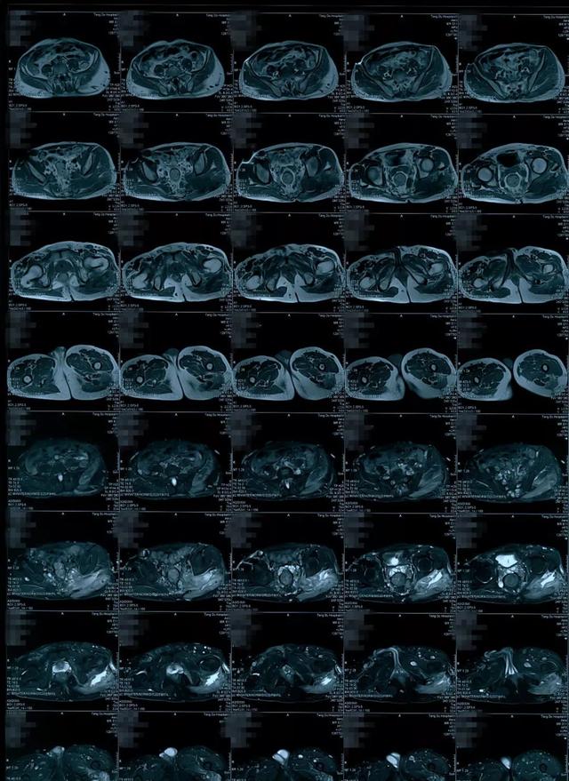 病例点评多发性神经纤维瘤