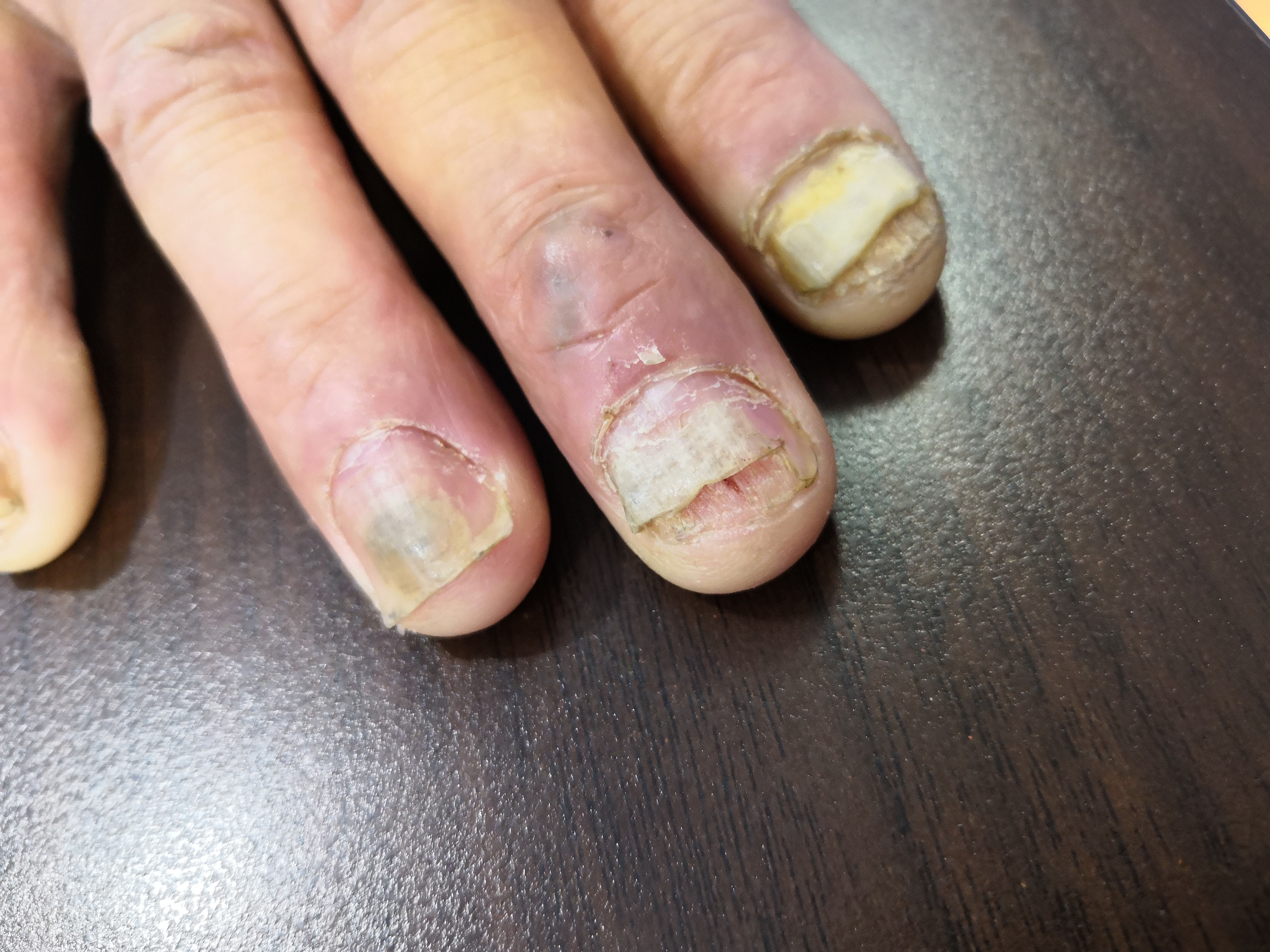 甲癣灰指甲知多少