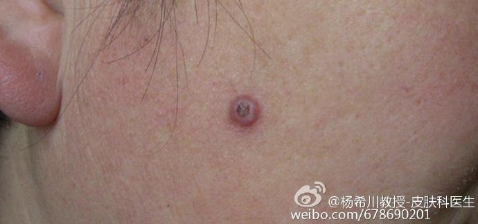 身上长了水猴子怎么破