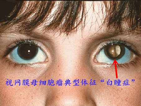 眼睛母细胞瘤症状图片图片