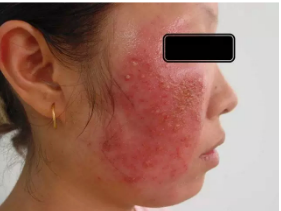 3,接触性皮炎脂溢性皮炎与玫瑰痤疮都可出现红斑和光加重现象,但皮损