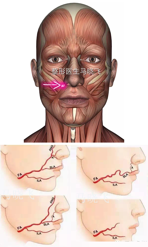 而这一区域最危险的地方在于血管,我们的面动脉就走行在鼻唇沟内,非常
