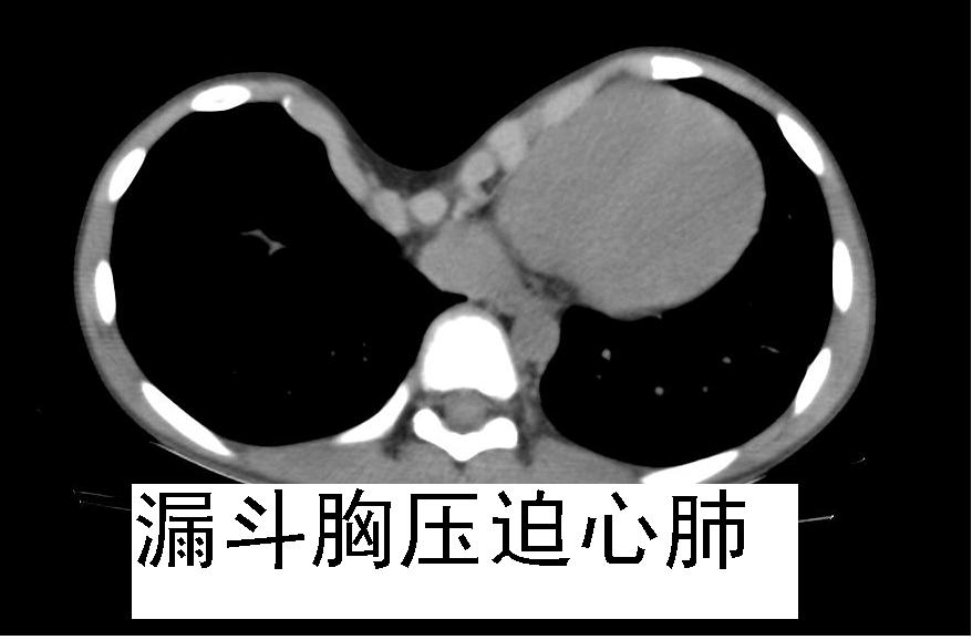 漏斗胸伤身又伤心,微创手术解烦忧!