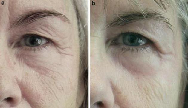 眼周肌肤松弛该如何治疗或护理?