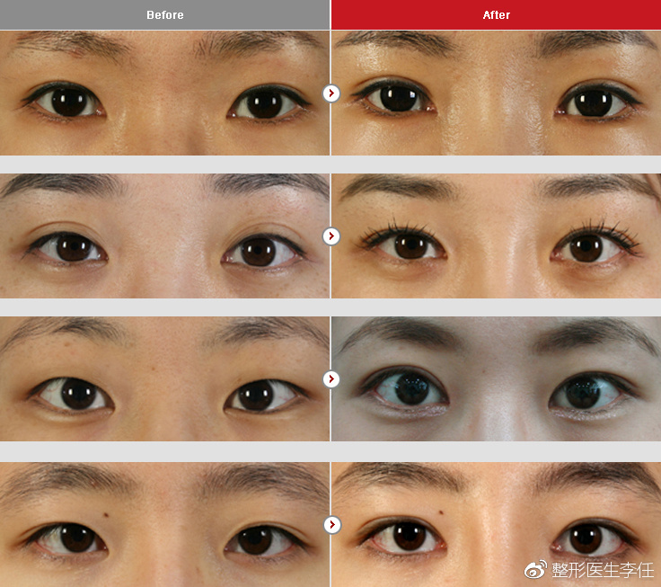 重睑术方式这么多如何进行选择