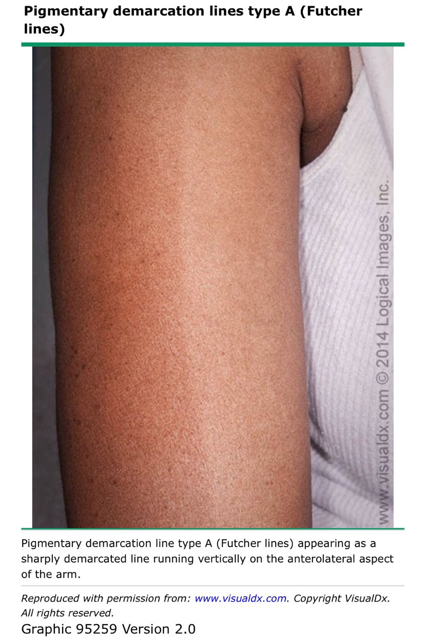 认识色素分界线!