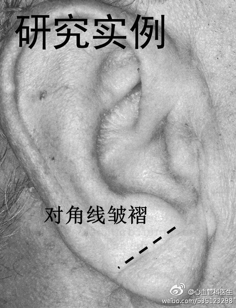 耳垂皱褶预示可能患冠心病了!