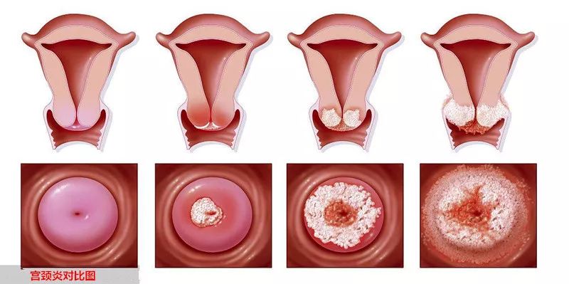 直击女性健康,带你了解宫颈炎的两大症状表现