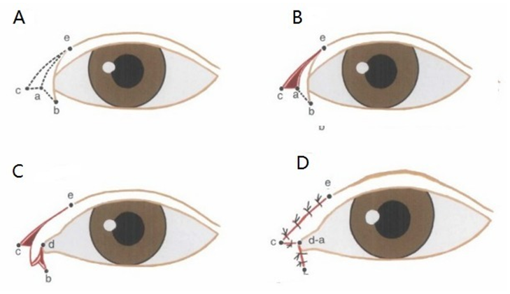 内眦整形:改良 z - 成形术矫正内眦赘皮
