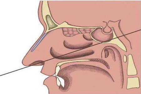 垂体瘤患者经鼻蝶手术出院后该注意哪些?