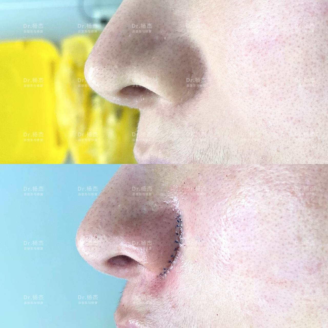 鼻翼疤痕修复切除