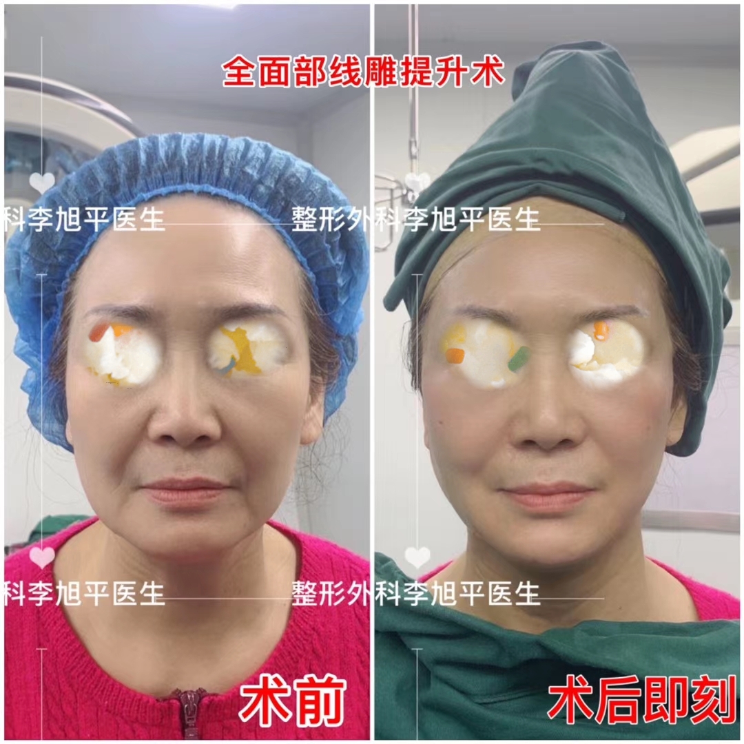 面部线雕后恢复过程分为两个阶段，术后一周左右为消肿_圈子-新氧美容整形