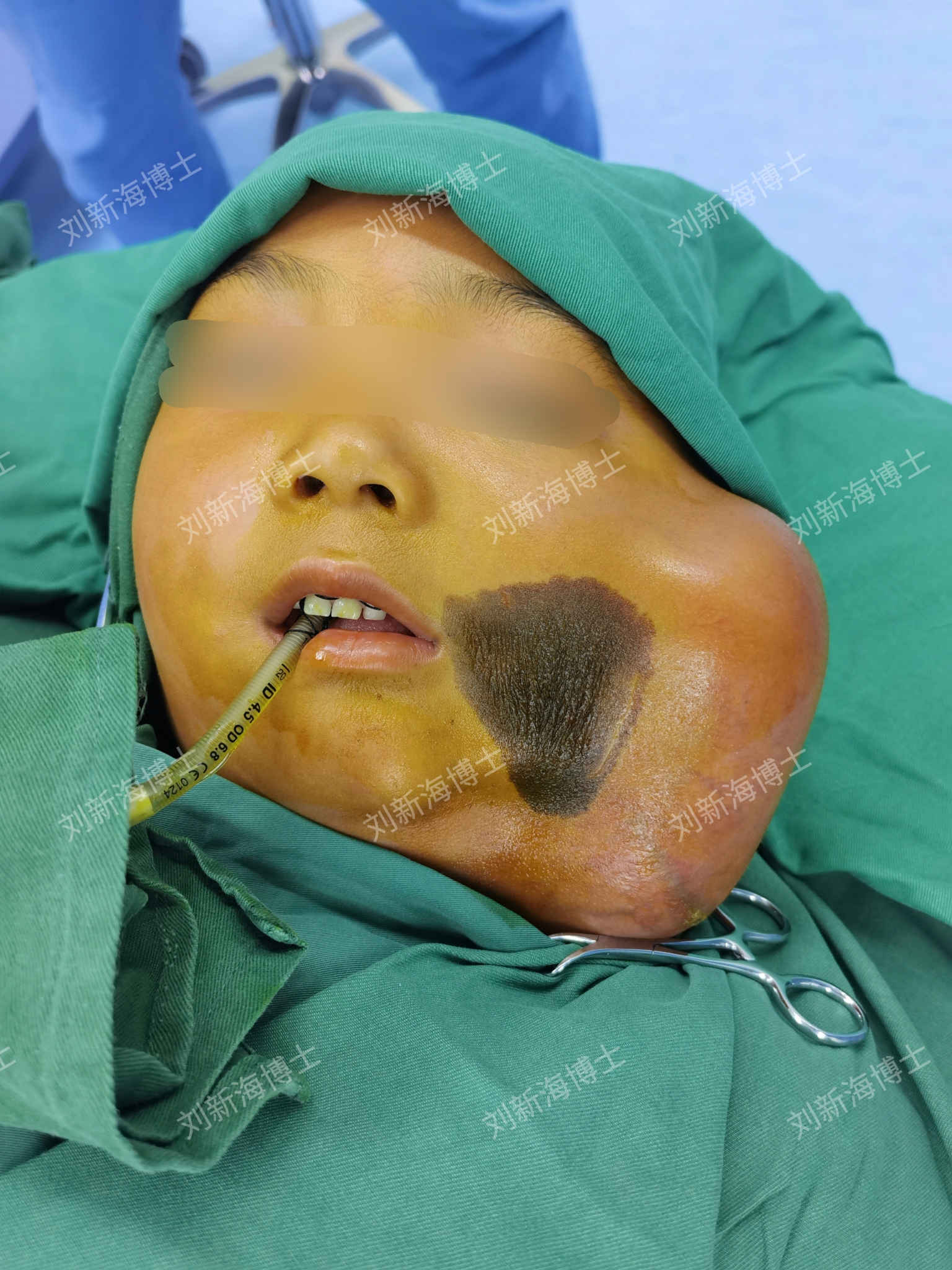 面部黑痣祛除 皮肤扩张培养术后即刻效果_刘新海_副主任医师_爱问健康