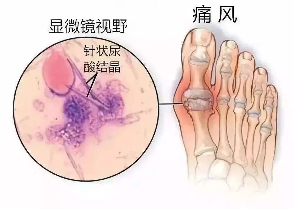 痛风能彻底治愈吗图片