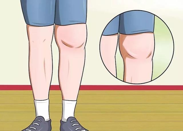 关于膝关节炎,你必须了解的3方面知识!