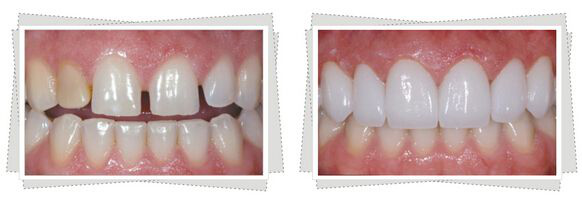 正常咬合时,牙齿相互接触,没有间隙.