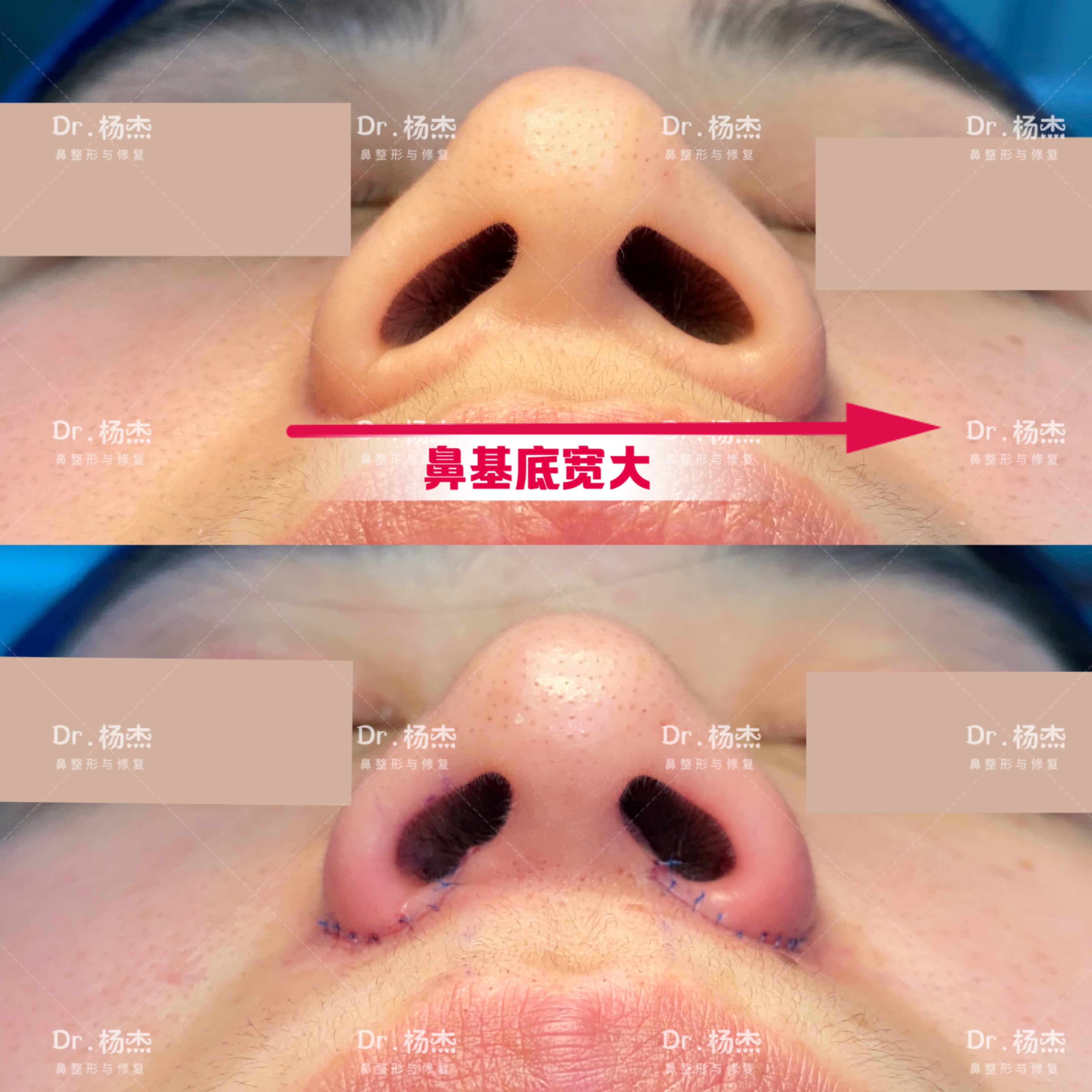 鼻翼内切缩小适合哪些人