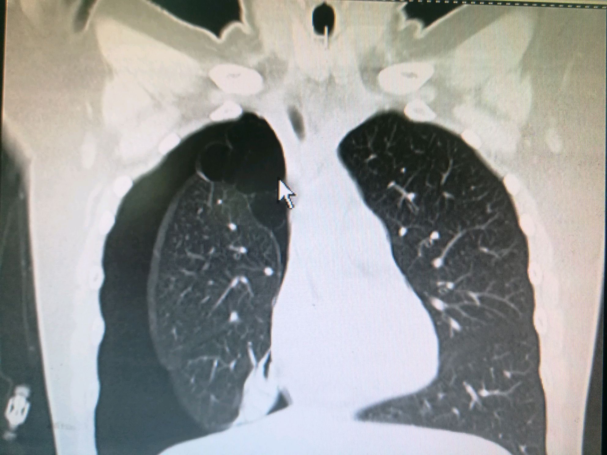 多发巨大肺大疱并自发性气胸病人1例