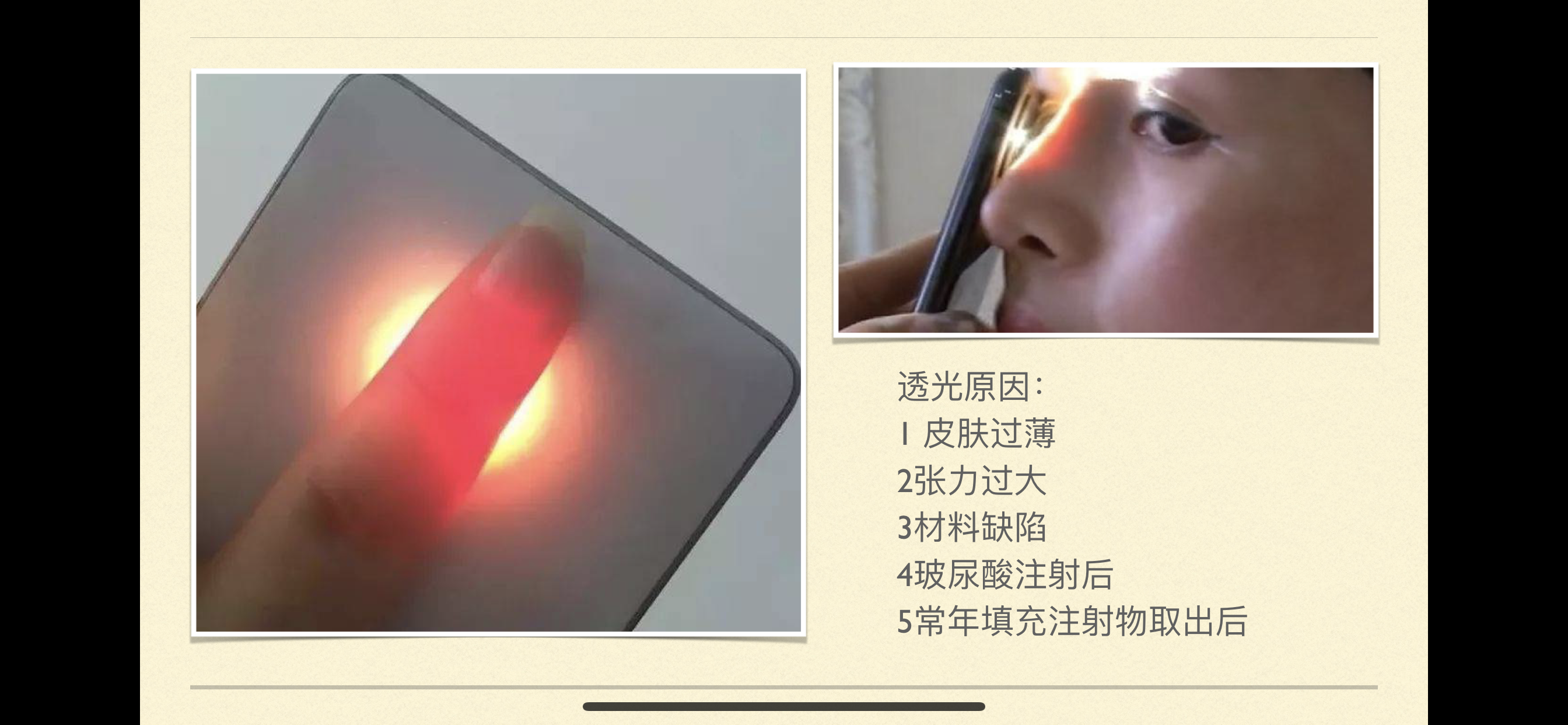 你的鼻梁为什么会透光