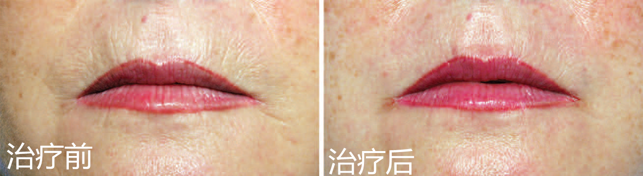 纳米脂肪治疗口周细纹纳米脂肪治疗胸前区乳沟部位晒伤后老化皱纹案例