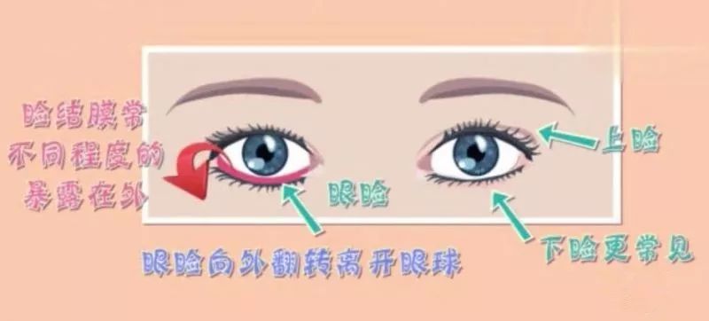 (ectropion) 是一種以瞼緣向外翻轉離開眼球為特徵的眼瞼位置異常