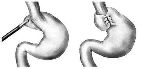 胃底折叠术神秘面纱