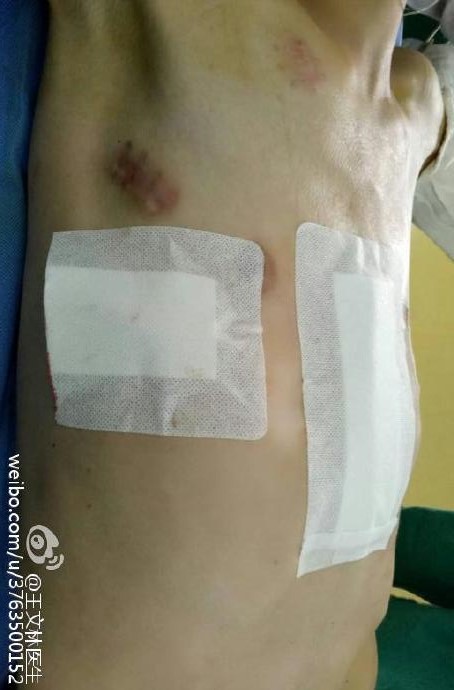 医学博士,工作微信:wangwenlindaifu,微信公众号《胸廓畸形手术专家》