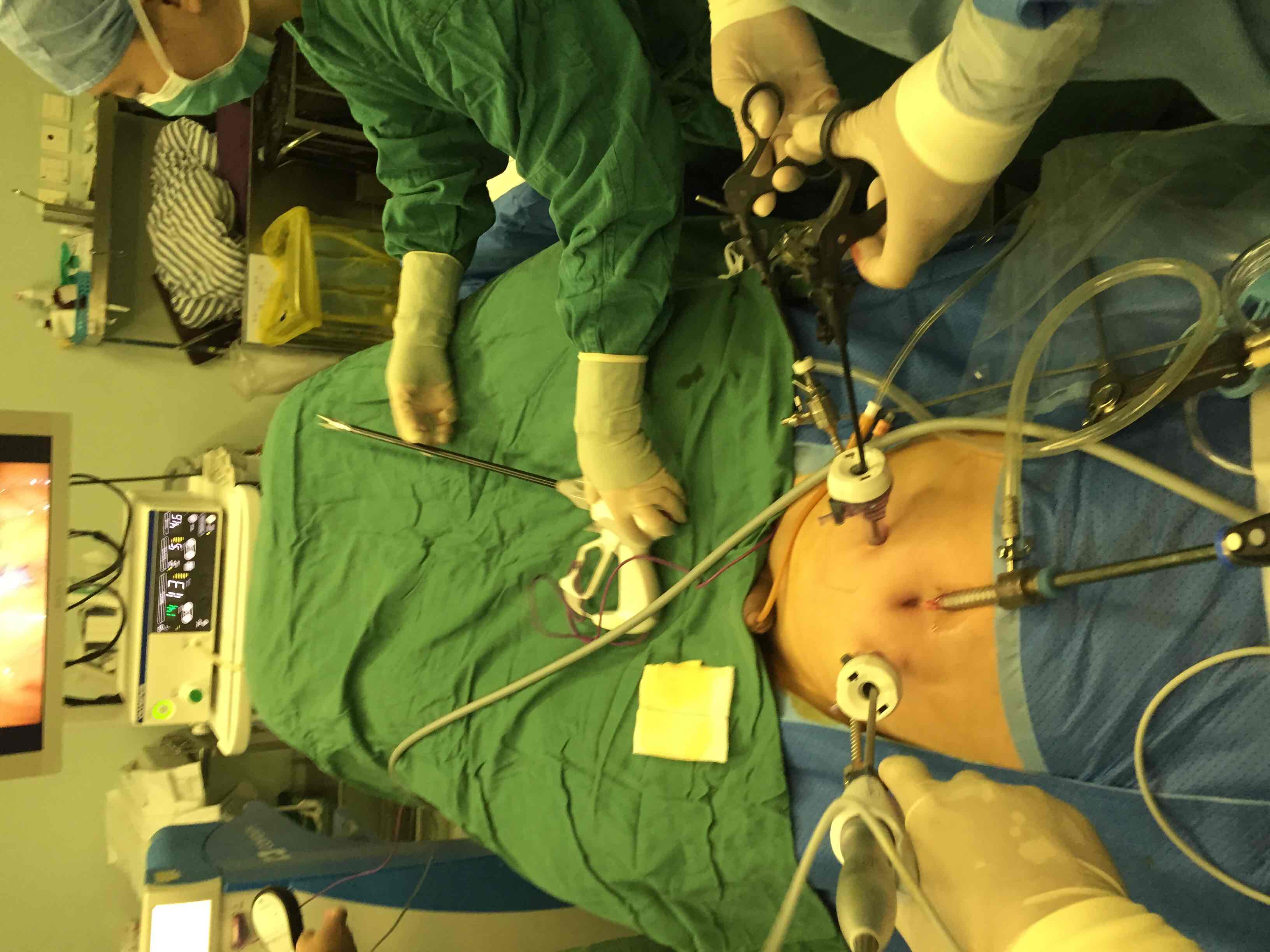 北大泌尿李学松教授实施完全腹腔镜膀胱全切mainz266手术