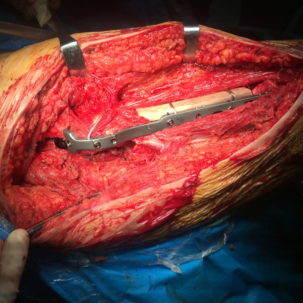 叶教授的关节日志5人工髋关节置换翻修