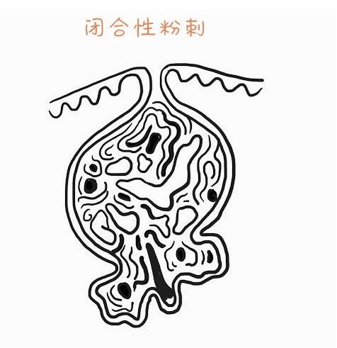 痤疮— 甲硝唑凝胶-简丹主任医师-爱问医生