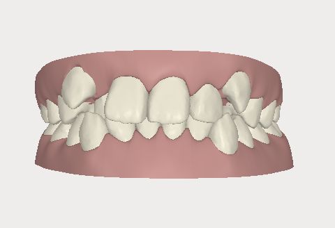 青少年必须处理的牙齿问题_李珊珊__爱问健康