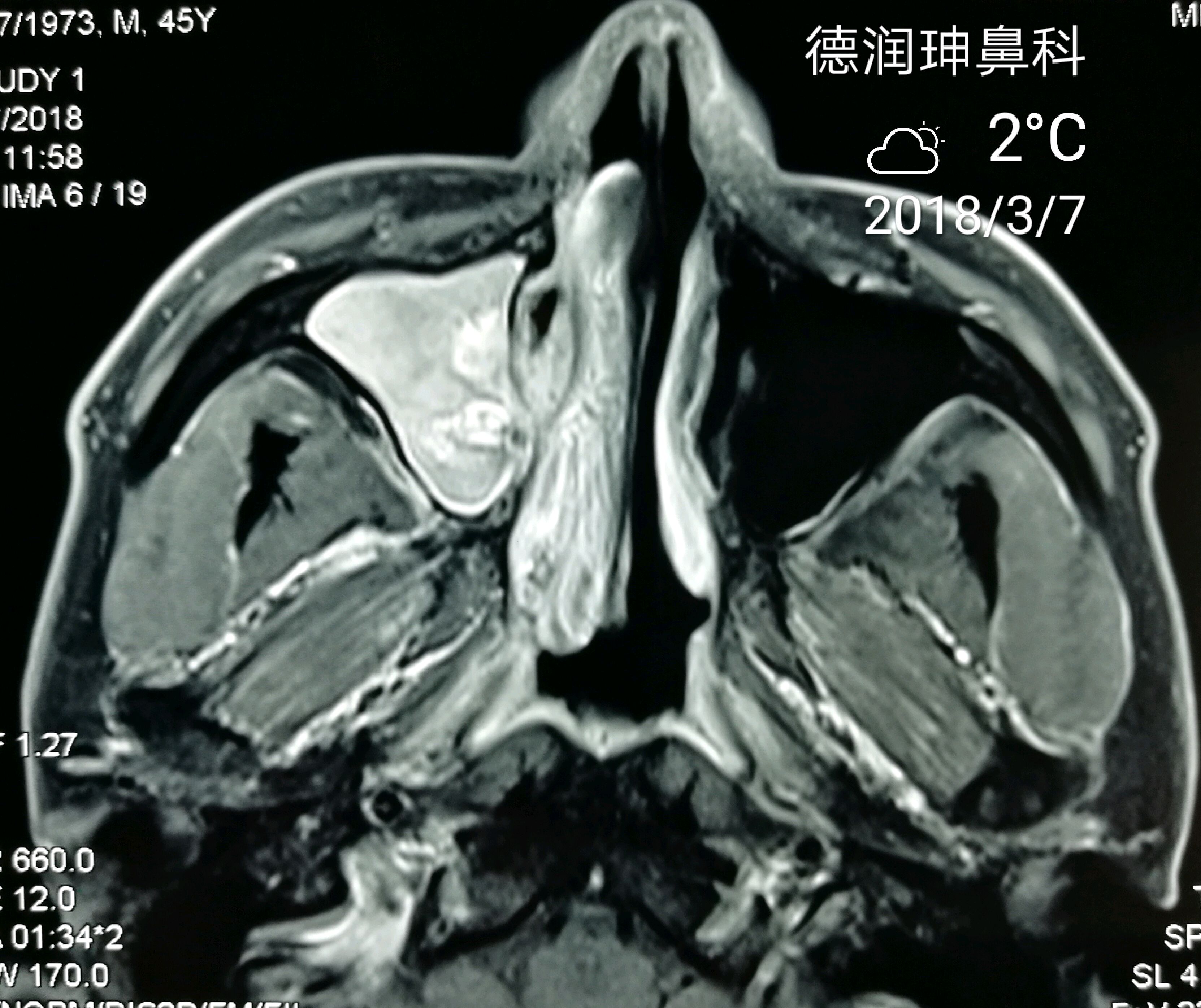 内翻性乳头状瘤一例
