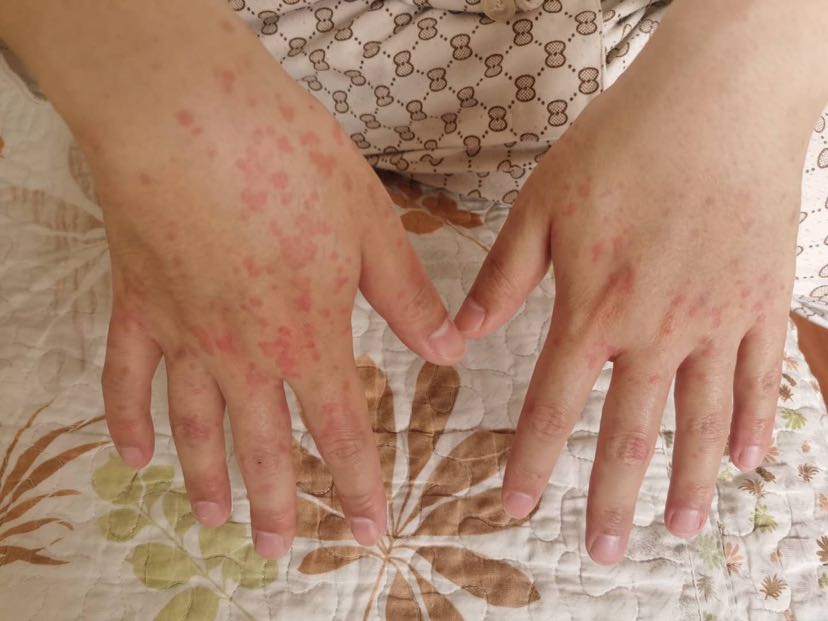 急性荨麻疹可能会出现喉头水肿出现窒息死亡建议尽快来急诊就诊