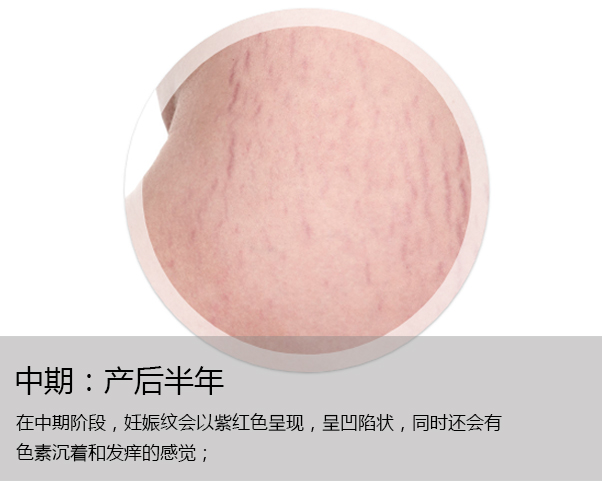 十个妈妈八个长,妊娠纹究竟应该如何去除?
