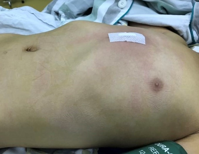 漏斗胸手术最新纪录:8分12秒,wang手术-王文林主任医师-爱问医生