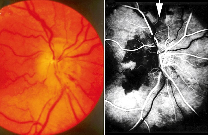 一项前瞻性对照研究,纳入696例连续的非动脉炎性前部缺血性视神经病变