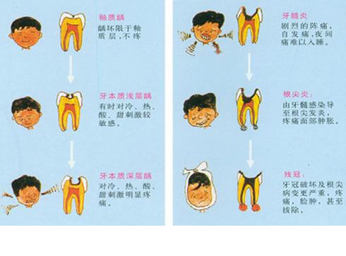 龋齿俗称蛀牙到底是怎么一回事