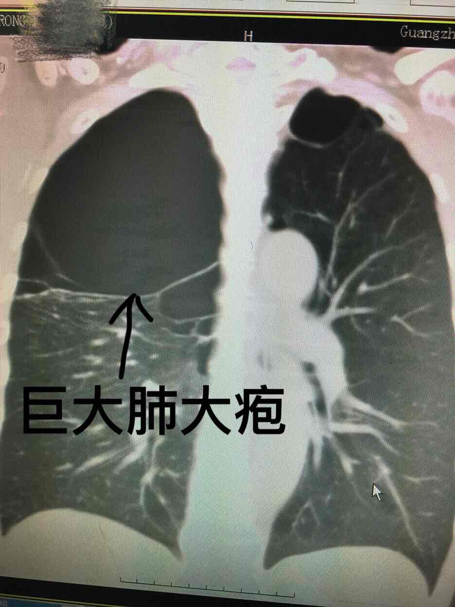 肺泡破裂图片图片